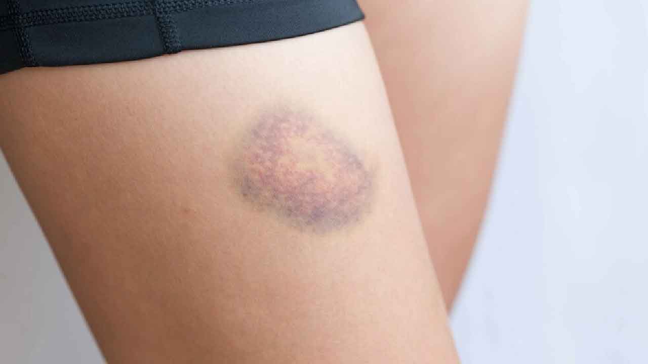 Effetto collaterale vaccini, la Sindrome da perdita capillare accentuata dopo il vaccino Janssen (Foto dal web)