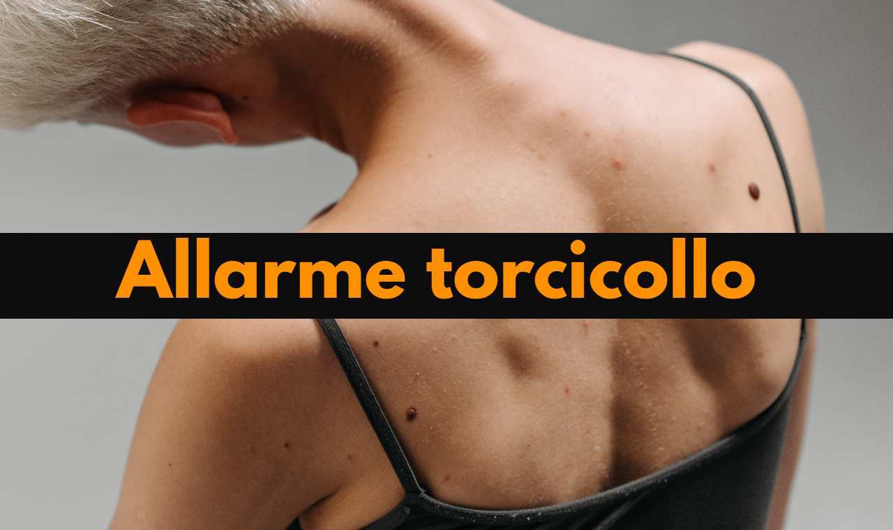 torcicollo