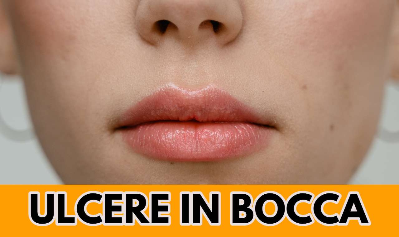 ulcere in bocca ck12.it 20220912
